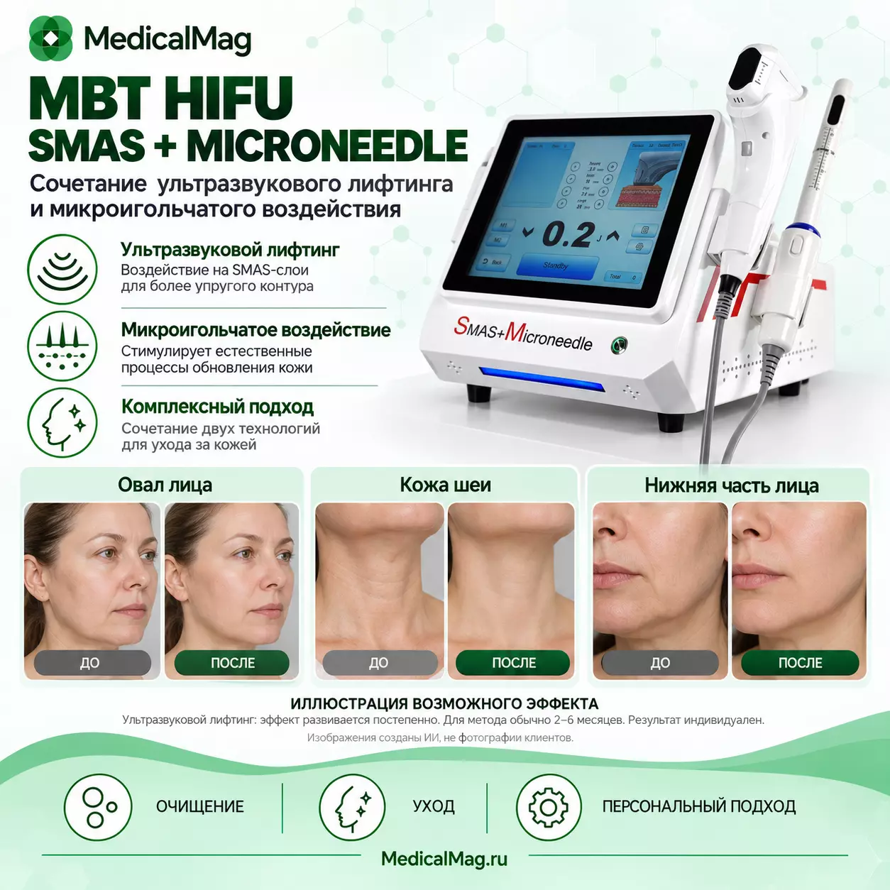 Аппарат смас лифтинга и микроигольчатого РФ лифтинга MBT HIFU SMAS + MICRONEEDLE