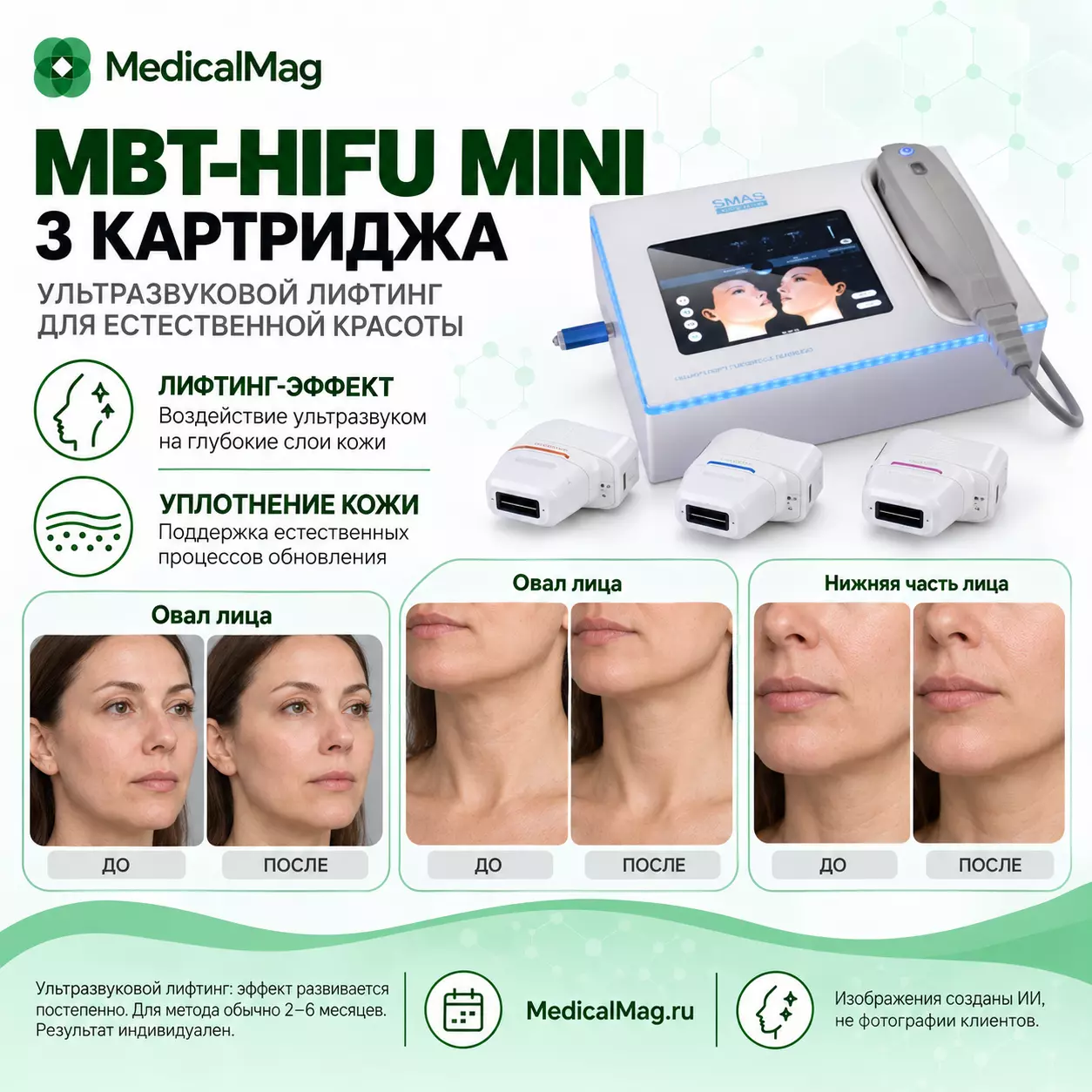 Портативный аппарат HIFU для SMAS лифтинга MBT-HIFU mini (3 картриджа)