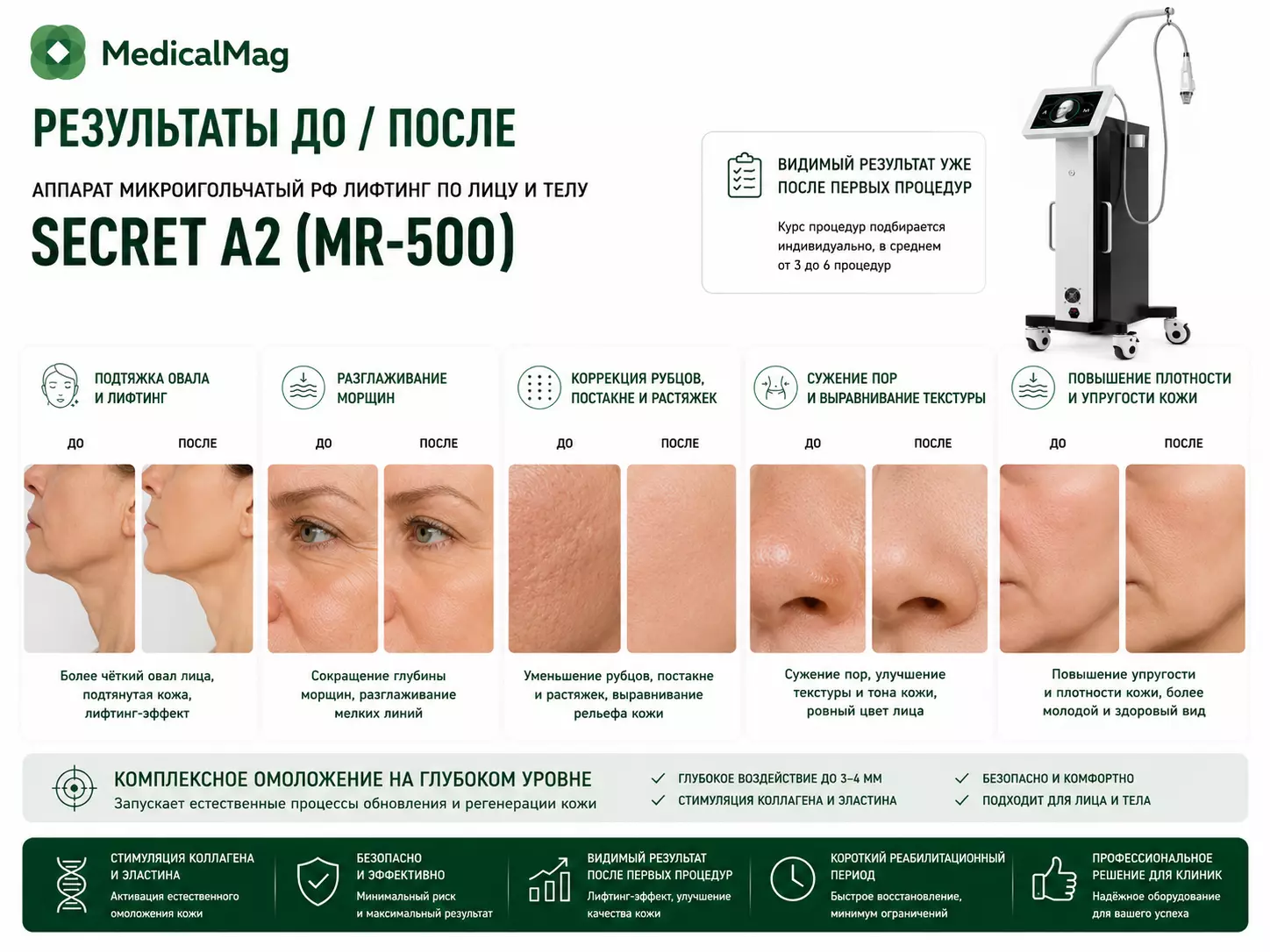 Аппарат микроигольчатый РФ лифтинг по лицу и телу Secret A2 (MR-500)