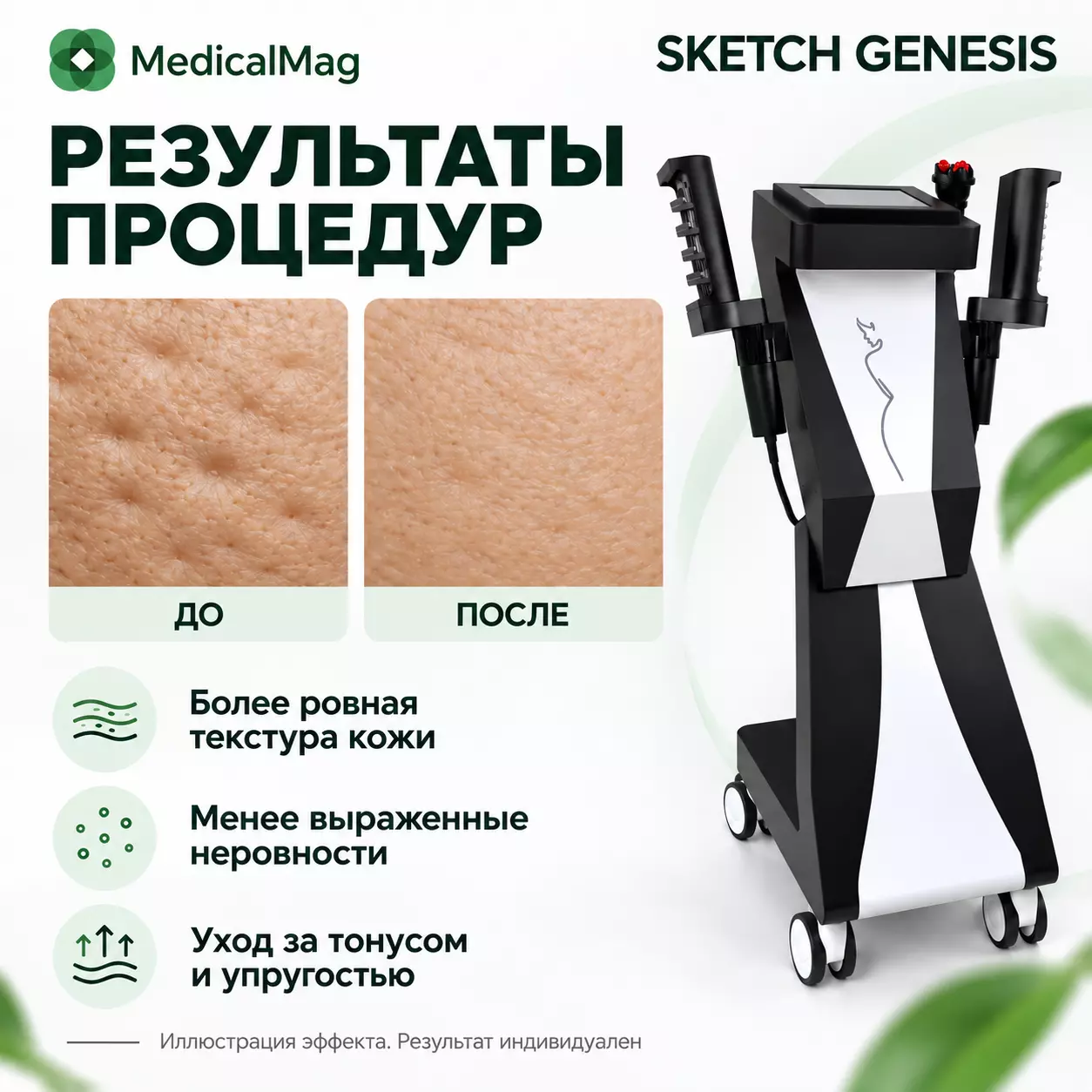 Аппарат роликового массажа Sketch Genesis